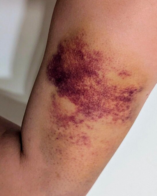 A protester shows a bruise they say was the result of an interaction with Hopkins police on May 8, 2025.