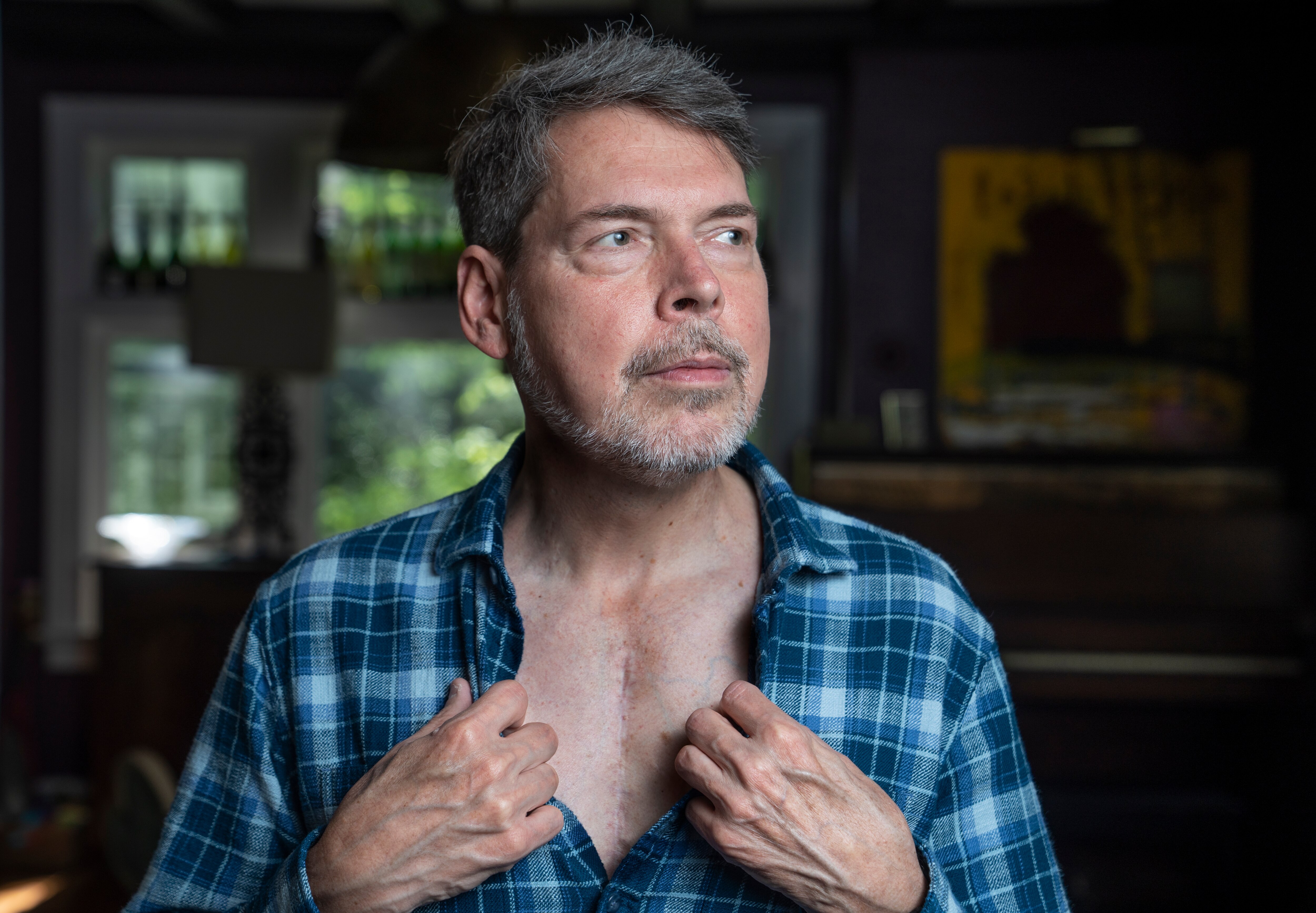 Restaurateur Tony Foreman shows the scars on his chest from numerous surgeries.